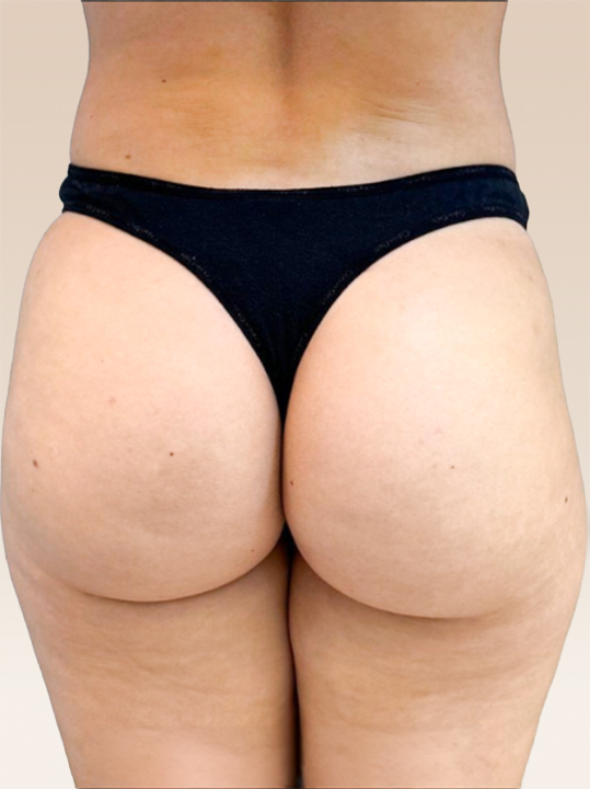 Result B&A - Body Contouring - BBL_After