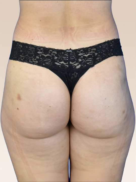 Result B&A - Body Contouring - BBL_Before