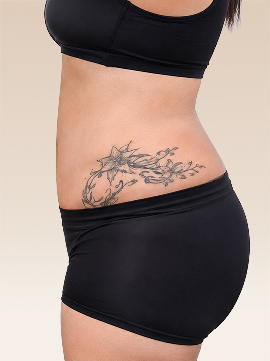 Result B&A - Body Contouring - Body Slimming & Contouring_After
