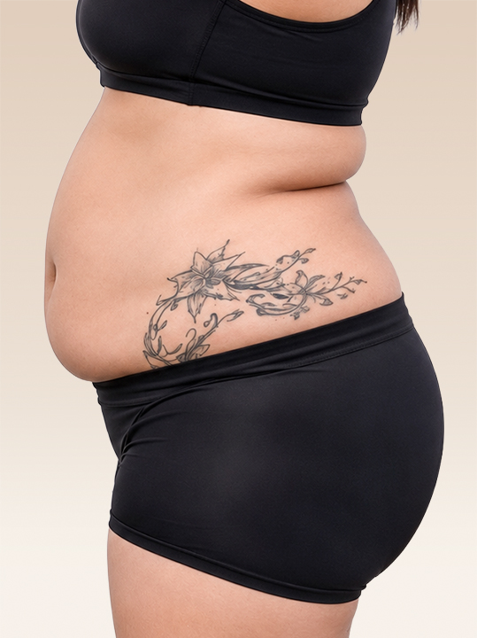 Result B&A - Body Contouring - Body Slimming & Contouring_Before