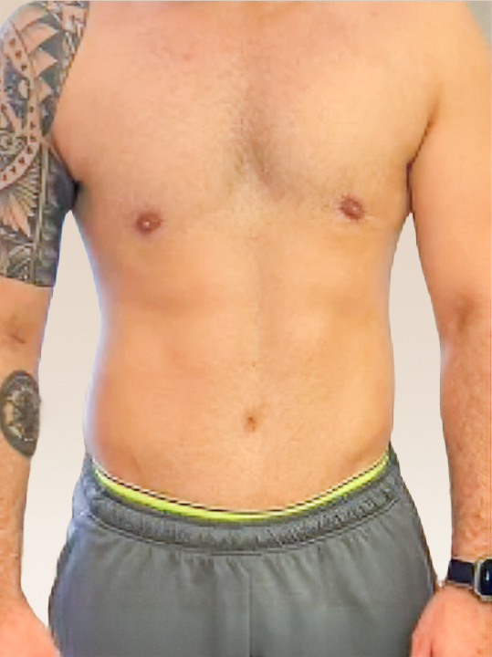 Result B&A - Body Contouring - Gynecomastia_After