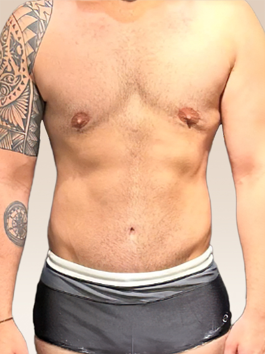 Result B&A - Body Contouring - Gynecomastia_Before