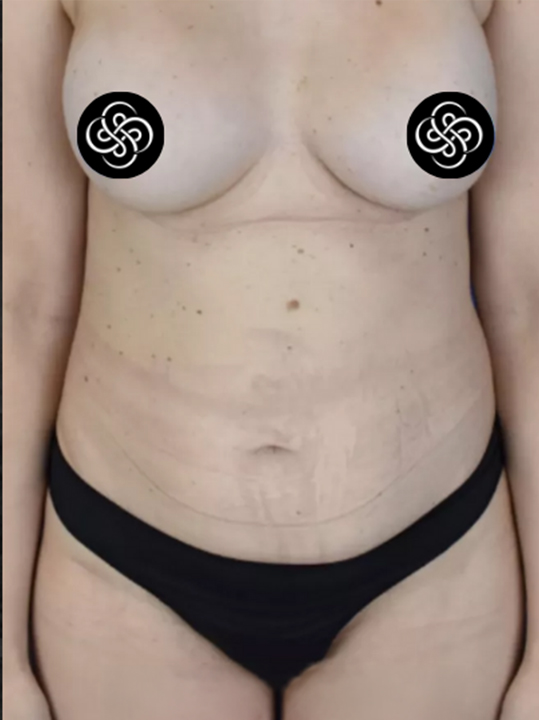 Result B&A - Body Contouring - Liposuction_Before