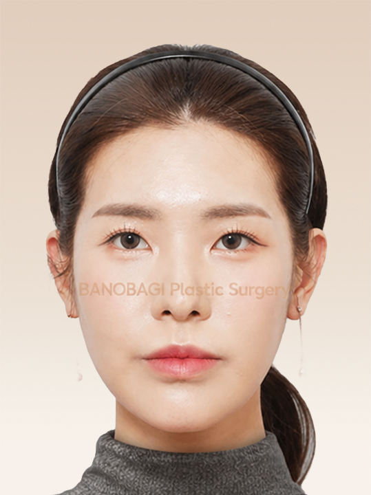 Result B&A - Cosmetic Surgery - Face Contouring_After