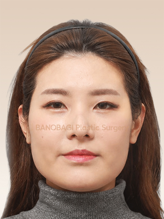 Result B&A - Cosmetic Surgery - Face Contouring_Before