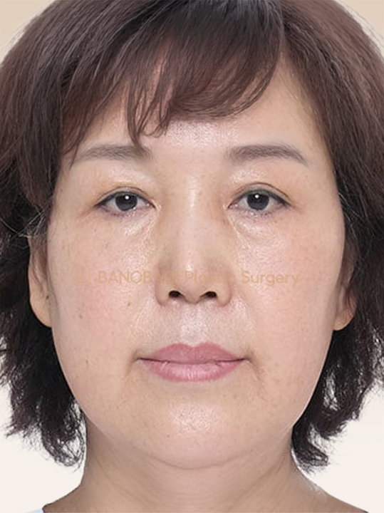 Result B&A - Cosmetic Surgery - Face Lifting_Before