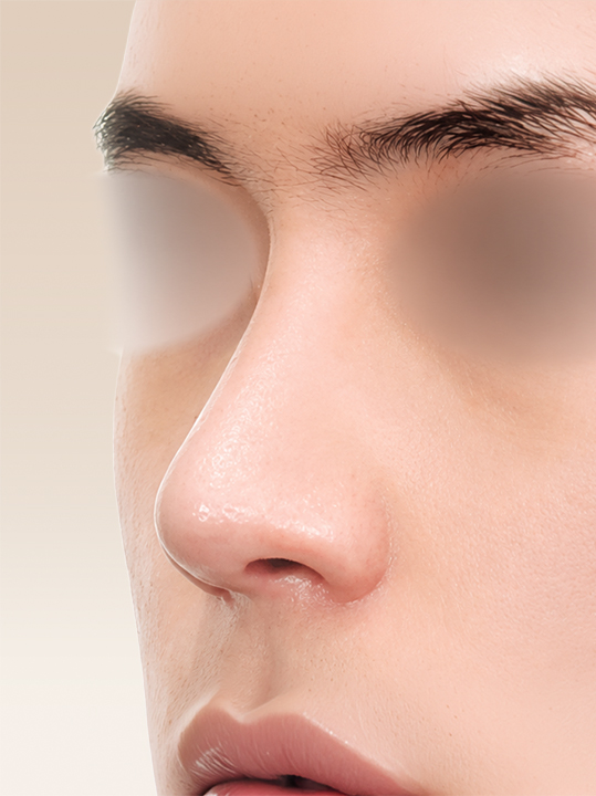 Result B&A - Cosmetic Surgery - Rhinoplasty_After