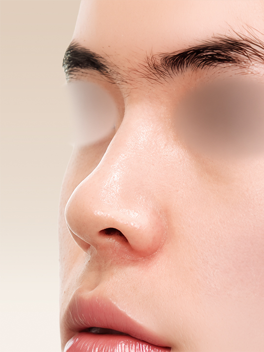 Result B&A - Cosmetic Surgery - Rhinoplasty_Before