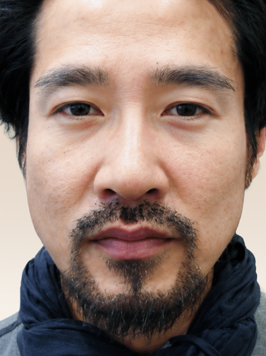 Result B&A - Hair Transplantation - Beard & Sideburn Graft_After