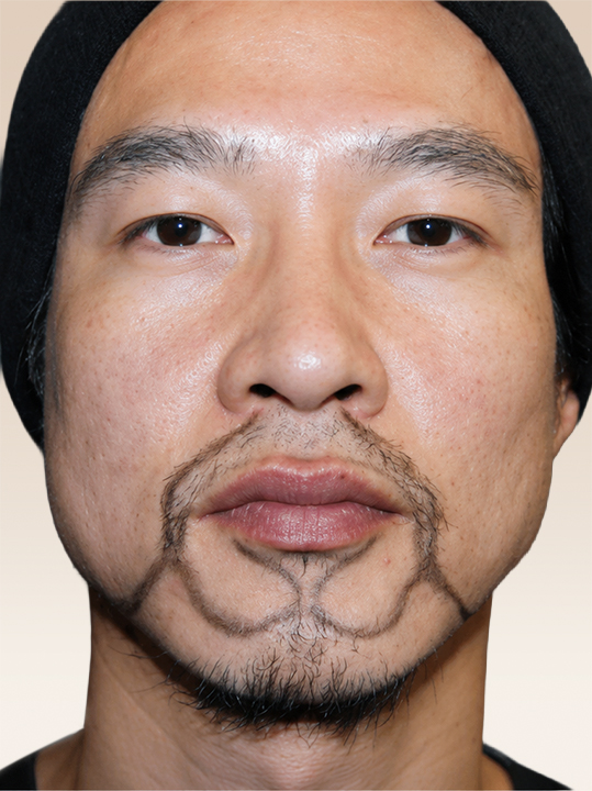 Result B&A - Hair Transplantation - Beard & Sideburn Graft_Before