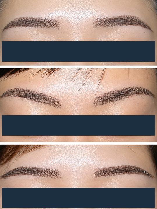 Result B&A - Hair Transplantation - Eyebrow Graft_After