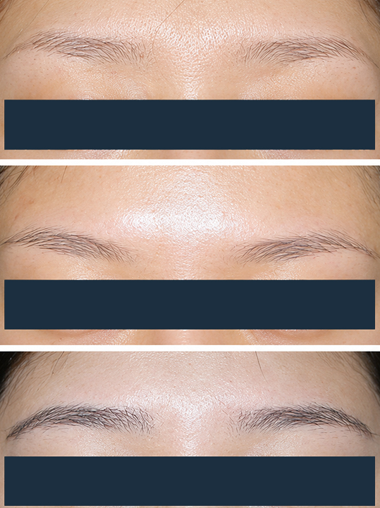 Result B&A - Hair Transplantation - Eyebrow Graft_Before
