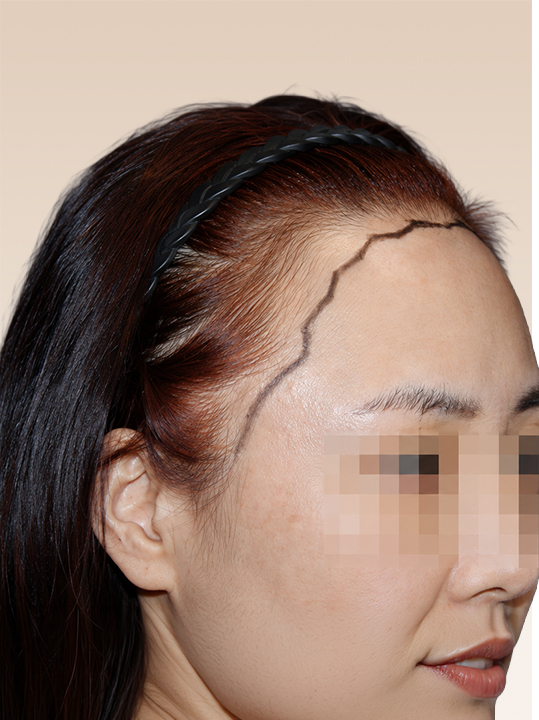 Result B&A - Hair Transplantation - Female Hairline Correction_Before
