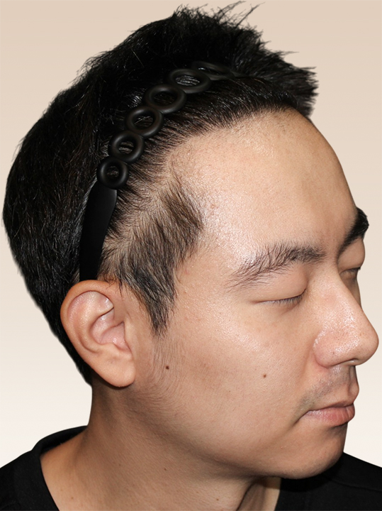 Result B&A - Hair Transplantation - Hair Transplantation_After