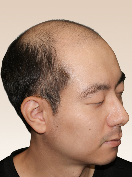 Result B&A - Hair Transplantation - Hair Transplantation_Before