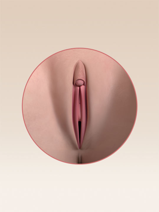 Result B&A - Intimate Rejuvenation - Clitoral Unhooding_After