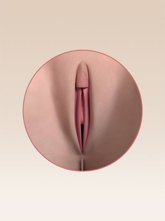 Result B&A - Intimate Rejuvenation - Clitoral Unhooding_Before