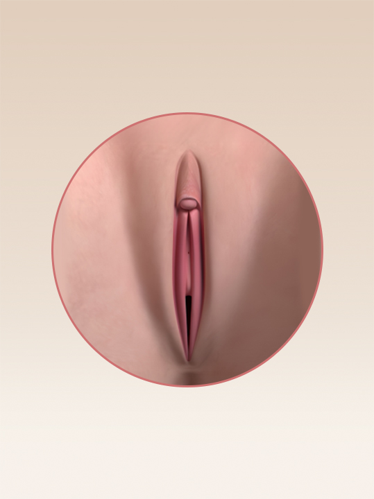 Result B&A - Intimate Rejuvenation - Labia Surgery_After