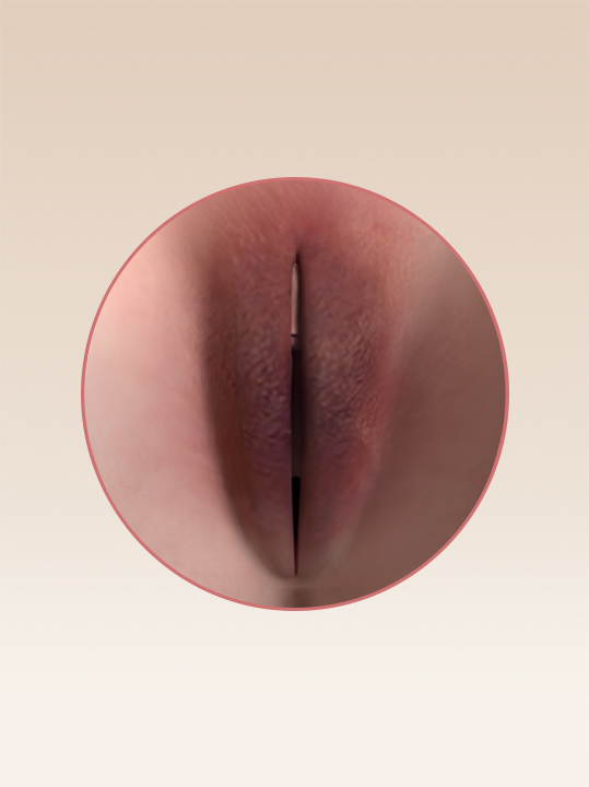 Result B&A - Intimate Rejuvenation - Labia Surgery_Before