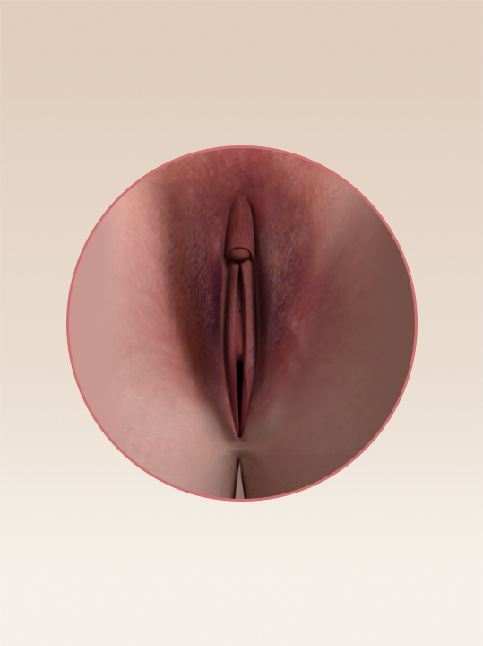 Result B&A - Intimate Rejuvenation - Vulvar Whitening_Before.jpg